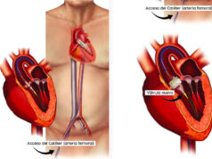 Épica historia de una mexicana: Reemplazo de Válvula Aórtica por Catéter